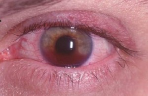 тромбоз центральной вены сетчатки глаза 